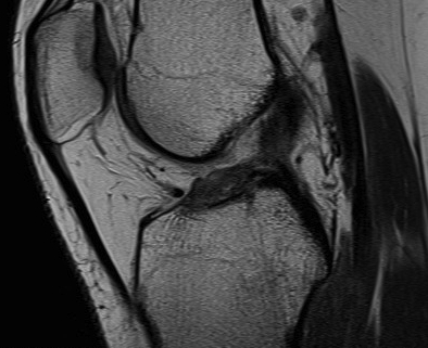 ACL Torn with remnant stump MRI